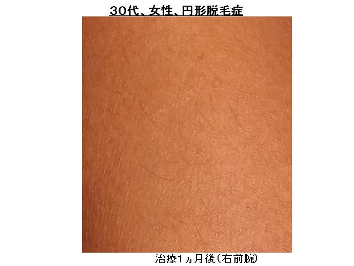 円形脱毛症　病院""
